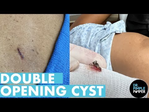 ⁣Double Opening Back Cyst